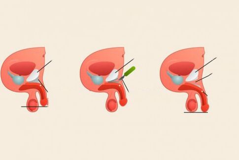 antes y después de la cirugía de agrandamiento del pene